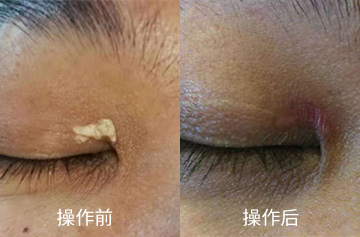 汗管瘤