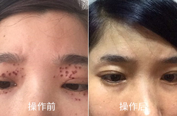 汗管瘤