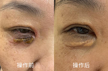 汗管瘤
