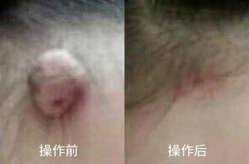 肉瘤