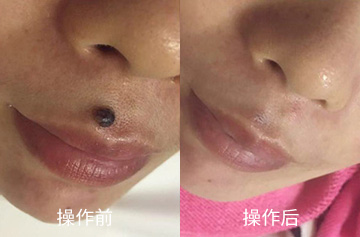 肉瘤