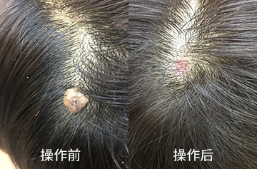 肉瘤