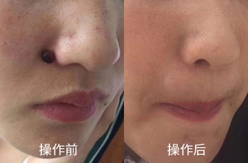 血管瘤