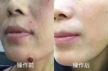 肉瘤